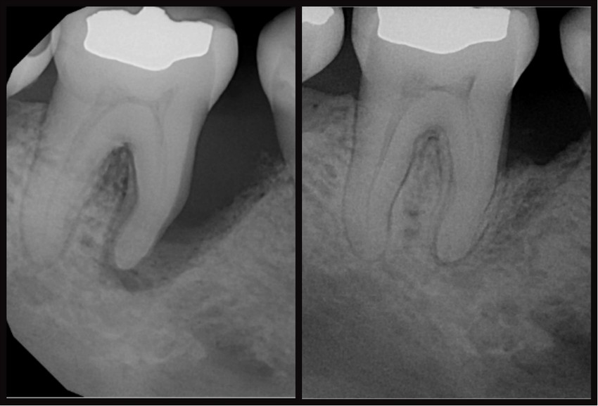 Kezeletlen fogágybetegség: így veszítsünk el egy fogat 10 év alatt (X)