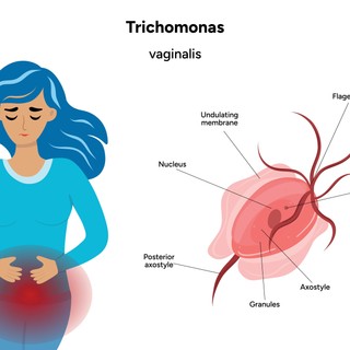 Trichomonas-fertőzés tünetei, vizsgálata és kezelési lehetőségei című cikk nyitóképe
