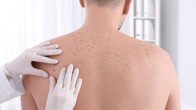 anyajegyszűrés, eltávolítás, veszély, melanoma