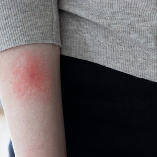 Ezért olyan nehéz időben diagnosztizálni a Lyme-kórt című cikk nyitóképe