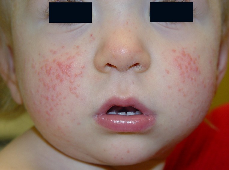 A Gianotti-Crosti szindróma jellemzően kisgyermekek (1-6 évesek) betegsége. Az általános tünetek viszonylag enyhék: láz, nyirokcsomó-duzzanat, máj- és lépmegnagyobbodás. 