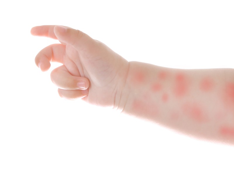 Kanyarójárvány Kelet-Szlovákiában: egyre többen betegek