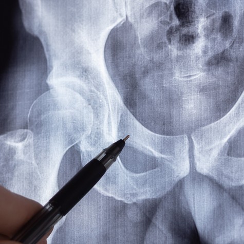 Mit tehetünk idősebb korban, hogy ne törjenek olyan könnyen a csontok? című cikk nyitóképe