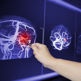 Mit jelent az agyi ödéma? Ezek az agyödéma okai, tünetei és kezelési lehetsőségei című cikk nyitóképe