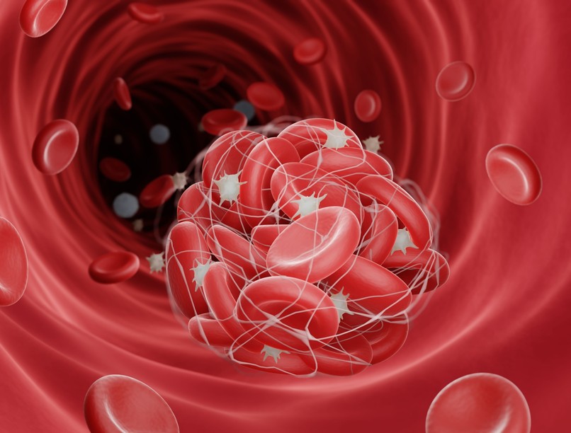 trombózis tüdőembólia megelőzés vérrög