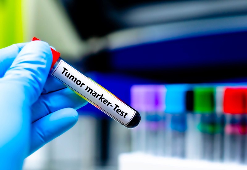 PSA, CA-125, CEA – Vajon mit jelentenek a leggyakoribb tumormarkerek?
