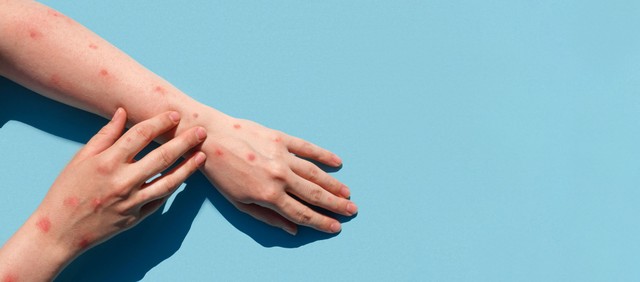 Majomhimlő vagy övsömör? Hasonlóak a tünetek, de van egy fontos különbség köztük