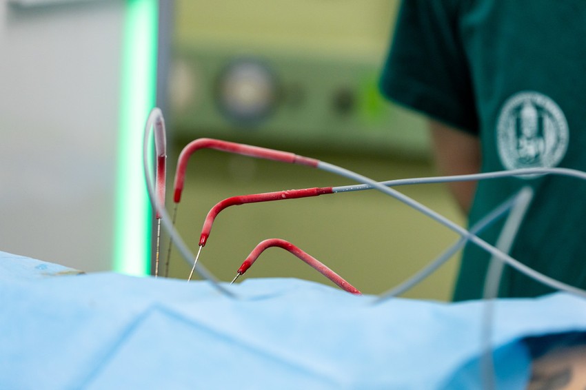 A daganatszöveteket -40 Celsius fokon roncsolják.