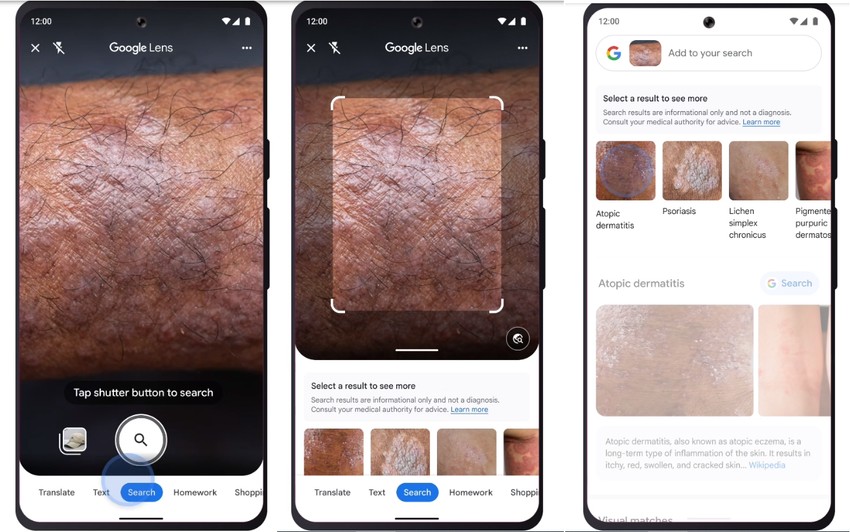 A Google Lens azután, hogy lefotóztuk a bőrünket és feltöltöttük a Lens-be, egy rakás olyan képet mutat majd, ami hasonlít a mi bőrükhöz. Így össze tudjuk hasonlítani, hogy a mi bőrünk mennyire hasonlít egy ismert bőrbetegséghez.