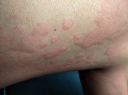 A legtöbb esetben gyorsan elmúlik, de ha hat hétnél tovább fennáll, krónikus csalánkiütésről beszélünk, ilyenkor orvosi kivizsgálás szükséges az ok felderítésére és a megfelelő kezeléshez, ami antihisztaminok szedéséből és a kiváltó ok elkerüléséből állhat. 

