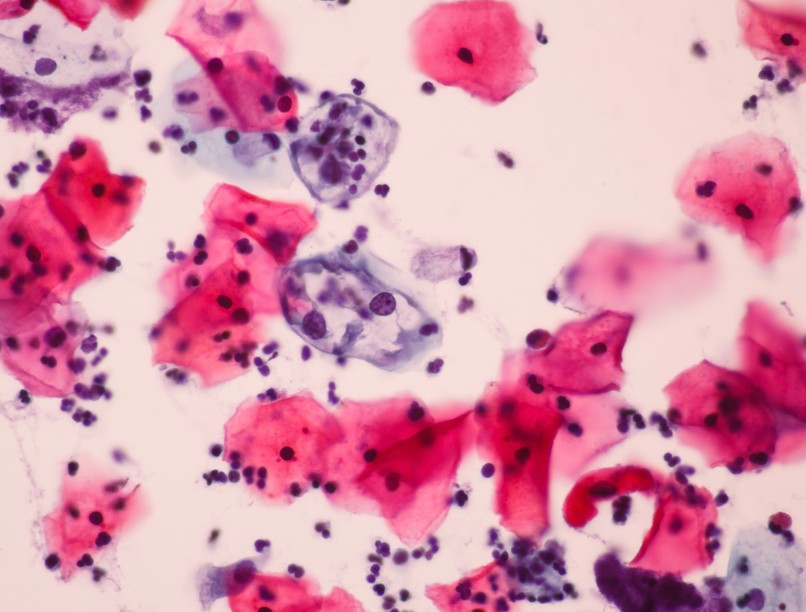 HPV vírus fertőzés hogyan lehet elkapni