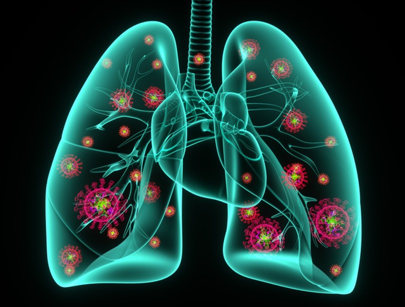 tüdőgyulladás, koronavírus, covid