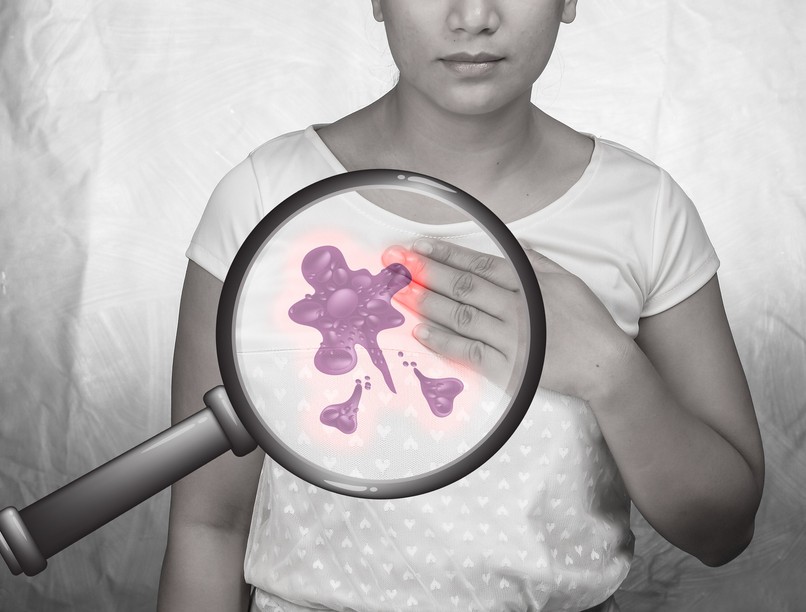 emlőrák mellrák ellen gombák