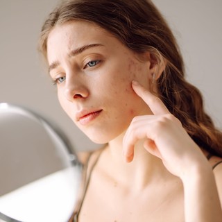 Mit tehetünk az akné ellen? Tünetek, okok és kezelési lehetőségek című cikk nyitóképe