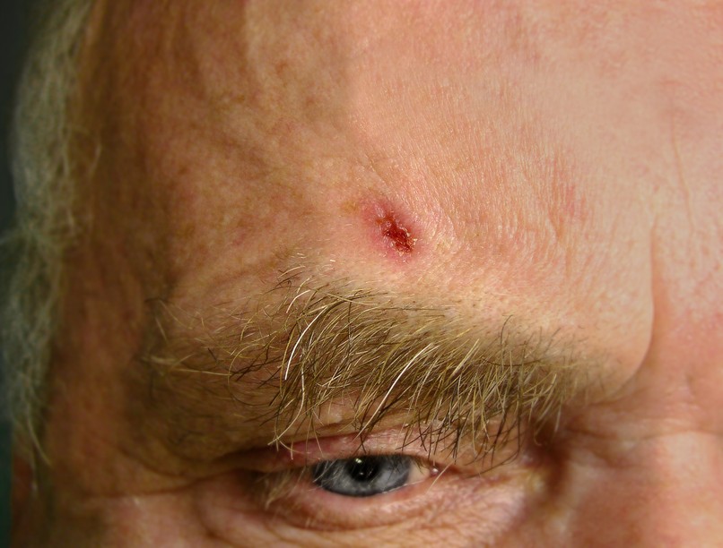 basalioma, laphámrák bőrrák jele nem gyógyuló seb fekély