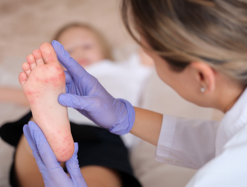 körömgomba, lábgomba, gyerek, kezelés