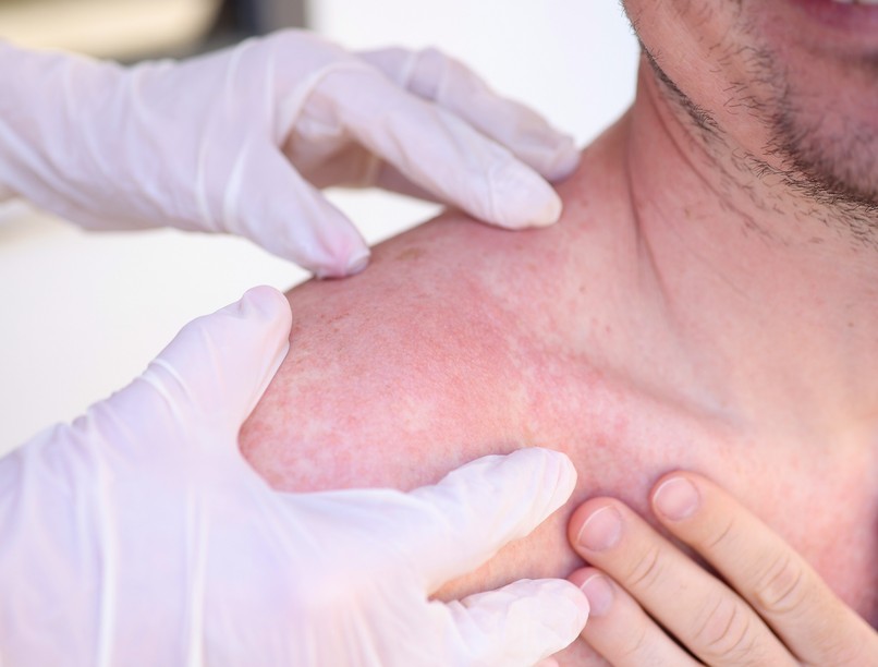 Mi a különbség a melegkiütés és a napallergia között