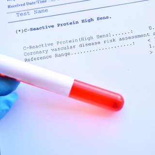 Mit árul el a CRP-érték az egészségi állapotunkról? Ezt üzeni a szervezete, ha a CRP-eredménye magas című cikk nyitóképe