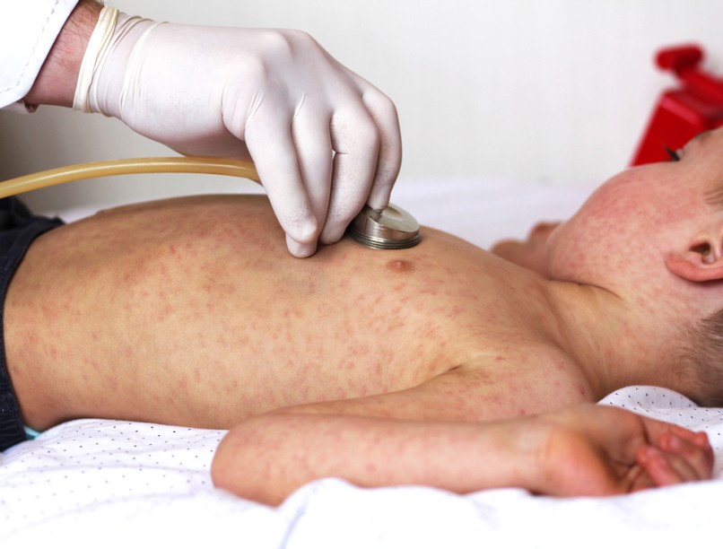 kanyarójárvány, kanyaró, amerika, New York