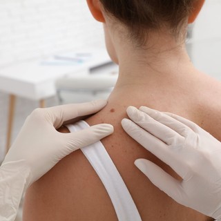 Eltávolítható az anyajegy akkor is, ha nem okoz gondot? című cikk nyitóképe