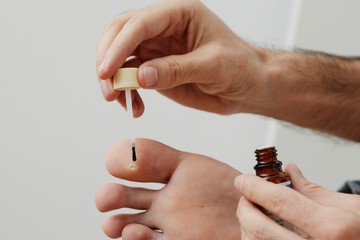 Szemölcs ellen házilag: ezek a legjobb otthoni módszerek, amik segíthetnek