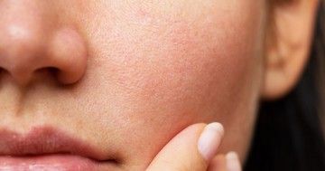  Sose nyomkodja a pattanásokat bizonyos helyeken! Ezt javasolja helyette a kozmetikus 