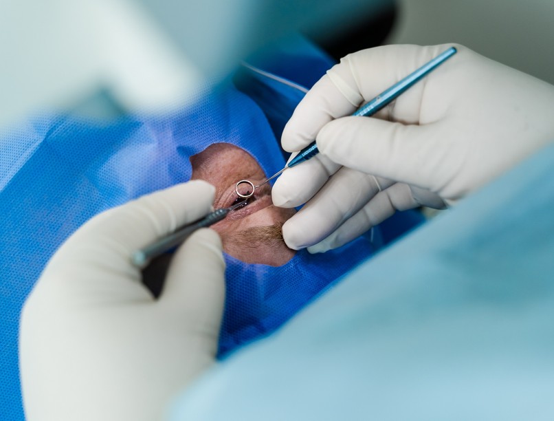 szürkehályog-műtét katarakta műtét leírás