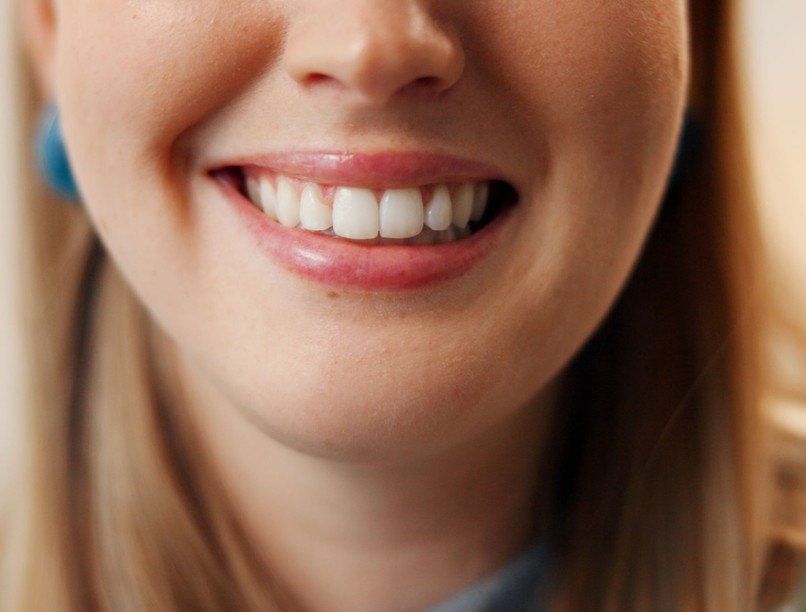 fogszuvasodás fog szín sárga szürke oka