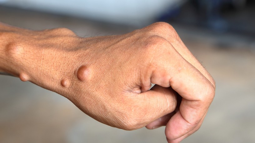 neurofibromatózis, majomhimlő, daganat, dudor