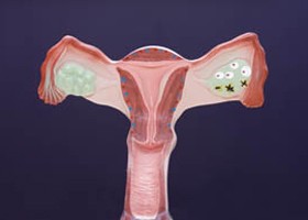 Policisztás ovárium (PCO) szindróma