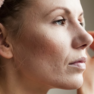 Pattanásos bőr felnőttkorban: ilyen kezelési lehetőségekben bízhat a szakértő szerint című cikk nyitóképe