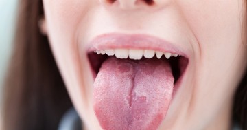 Szőrös, csipkés vagy lepedékes? Így tükrözi a nyelvünk állapota belső szerveink egészségét