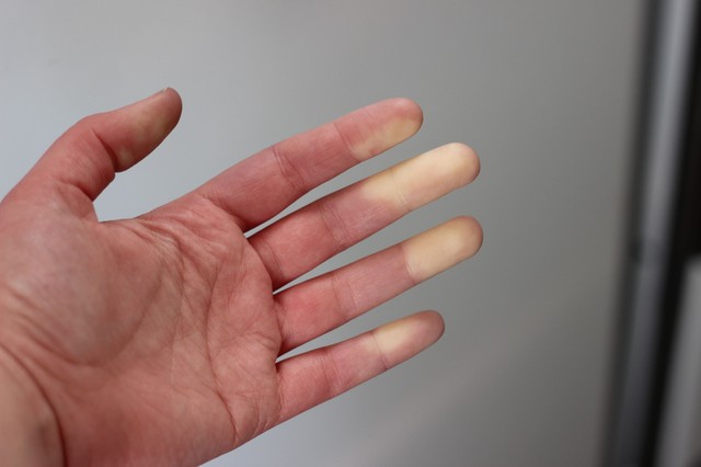 Ezek a gének lehetnek felelősek az egyik autoimmun betegségért