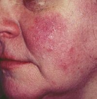 Létezik tartós megoldás is a rosacea-ra