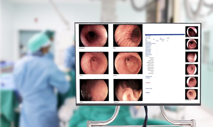 Normális esetben ilyen vékonyka a vastagbél fala - mire utal az, ha már megvastagodott? című cikk nyitóképe