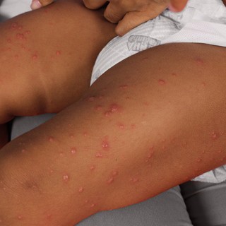 Gianotti-Crosti szindróma: tünete, vizsgálata és kezelési lehetőségei című cikk nyitóképe