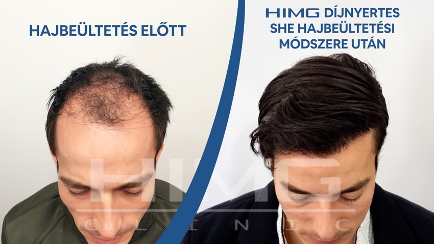 Hajhullás okai és megoldásai: Mikor szükséges a hajbeültetés?