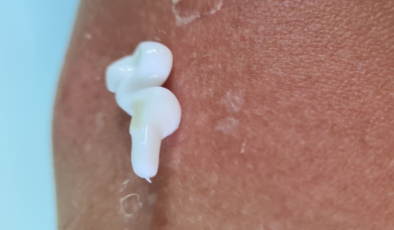 Ha legyengül a szervezete, nagyobb eséllyel támadják meg a bőrét ezek a gombák