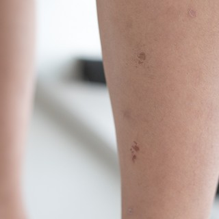 Kaposi-szarkóma: tünetek, lefolyás, kezelési lehetőségek című cikk nyitóképe