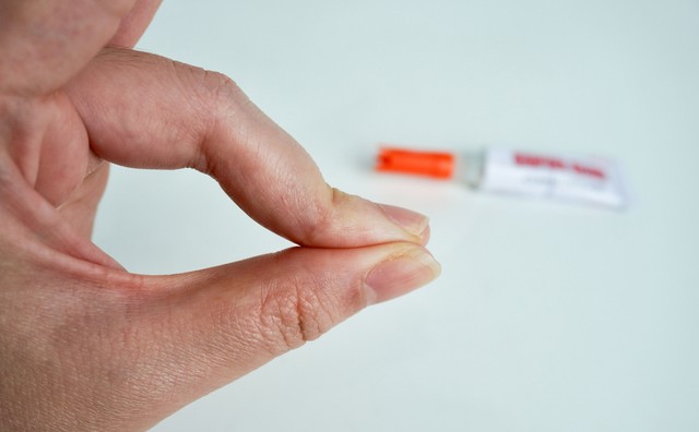 Így távolíthatja el a pillanatragasztót a bőréről