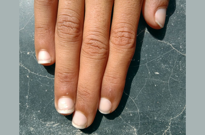 Körmünk alakjának, színének és állagának megváltozása jelzés lehet nem csak önmagának, de az orvos számára is.