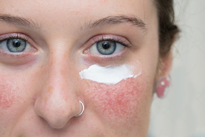 Rosacea és UV sugárzás: hogyan védekezzünk? című cikk nyitóképe