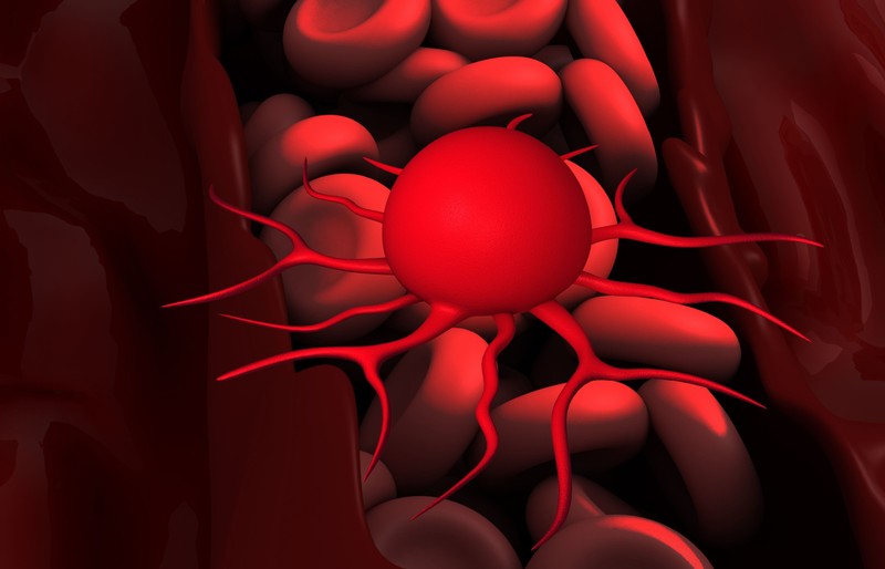 Vastagbélrák: ezzel a vizsgálattal már nagyon korán kiszűrhető