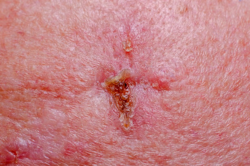 Kezdetben egyszerű sebnek tűnhet, pedig bőrrák: szokatlan tünetek is figyelmeztethetnek basaliomára