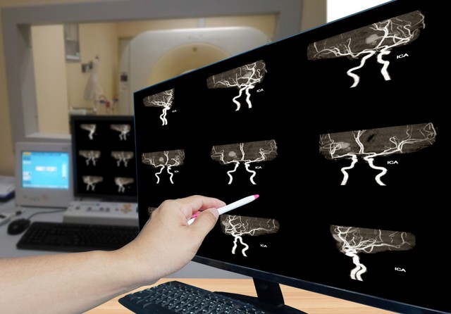 Vérzéses stroke – ez történik, amikor az agyban egy ér megreped