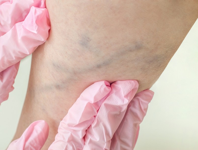 lábak visszér fájdalom trombózis tünete jele oka