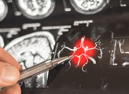 Forradalmi fordulat az Alzheimer-kutatásban: a K-vitamin új változata képes újjáépíteni az agysejteket című cikk nyitóképe