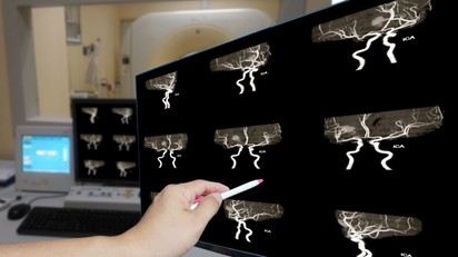 Vérzéses stroke – ez történik, amikor az agyban egy ér megreped című cikk nyitóképe