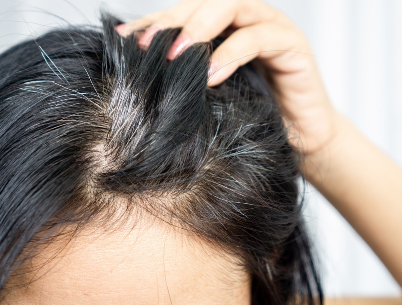 korai őszülés oka stressz