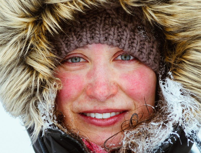 bőrpír, oka, arcpír, hideg, meleg